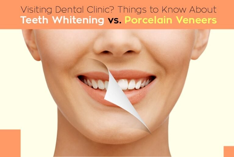 teeth-whitening-vs-porcelain-veneers